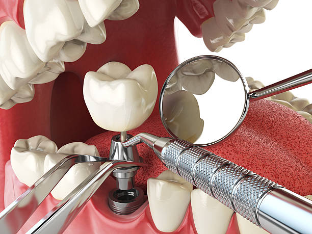 Best Emergency Wisdom Teeth Removal in Laware City, DE